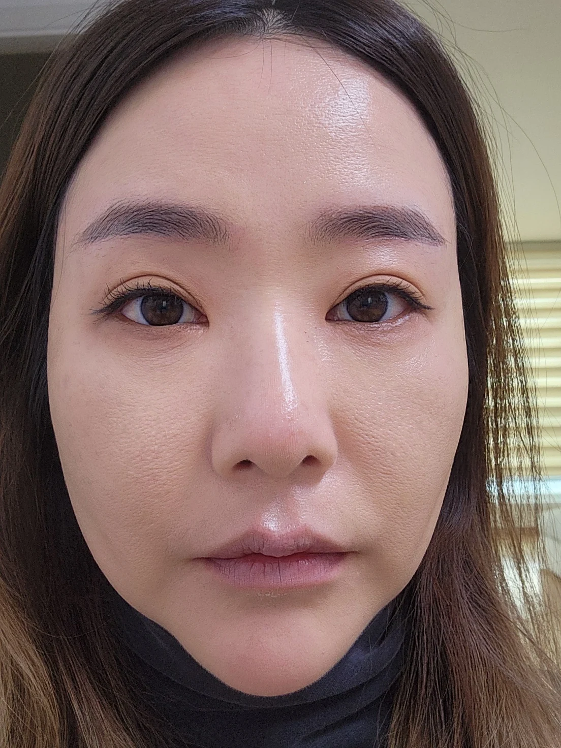 Eye-area surgery: before and recovery through four months · Case 046 at Answer Plastic Surgery. Front view 1 month at Answer Plastic Surgery.