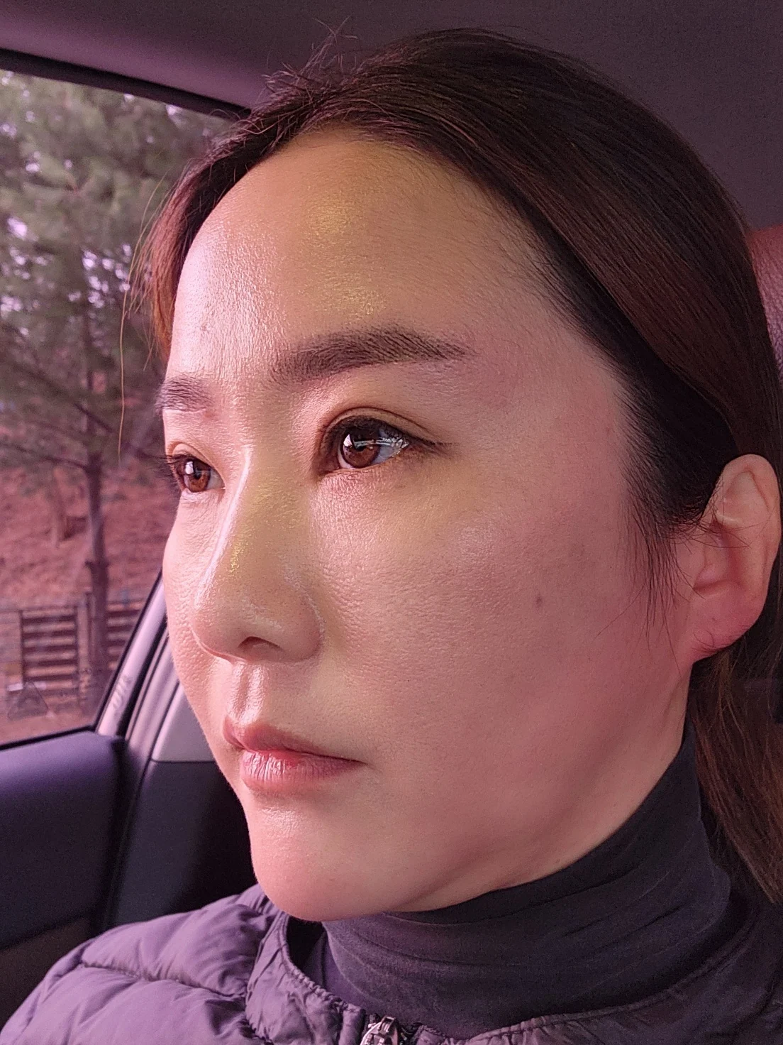 Eye-area surgery: before and recovery through four months · Case 046 at Answer Plastic Surgery. Angled view 1 week at Answer Plastic Surgery.