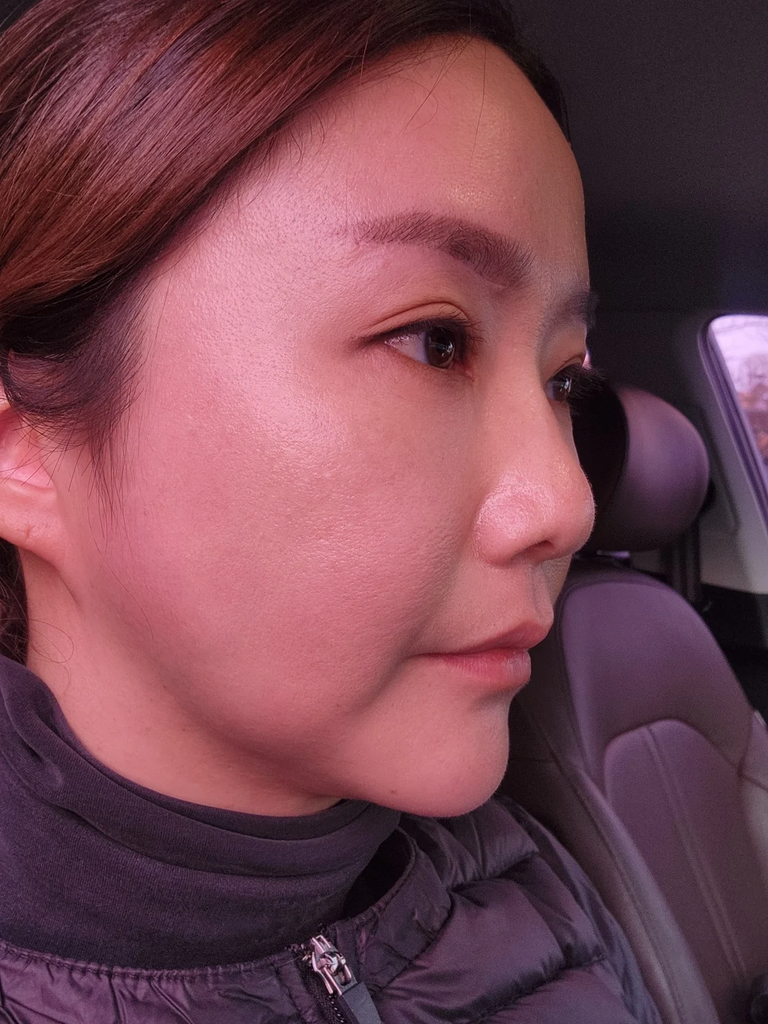 Eye-area surgery: before and recovery through four months · Case 046 at Answer Plastic Surgery. Opposite angled view 1 week at Answer Plastic Surgery.