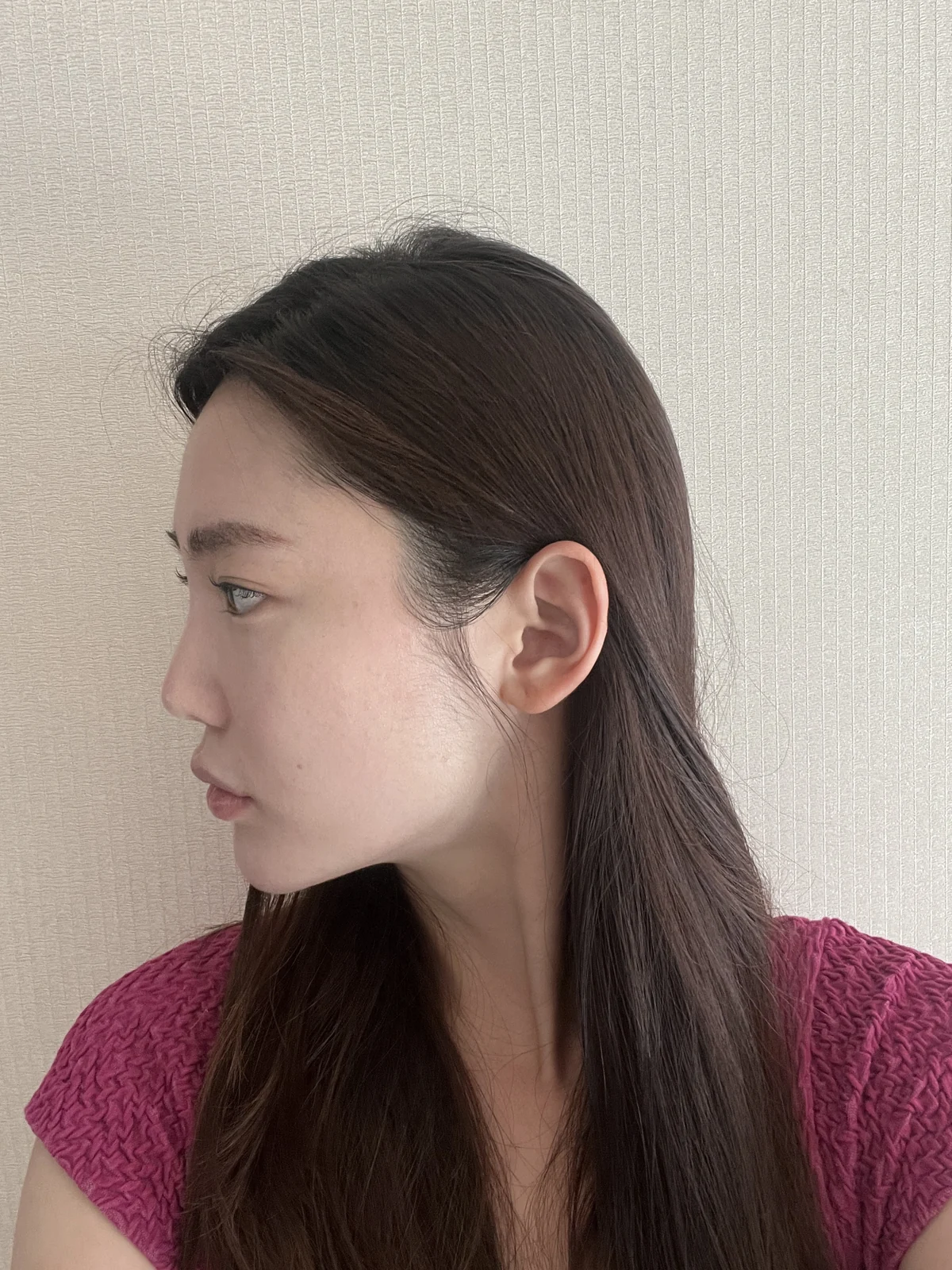Facial before-and-after photographs through two months · Case 023 at Answer Plastic Surgery. Profile view of the face — before at Answer Plastic Surgery.