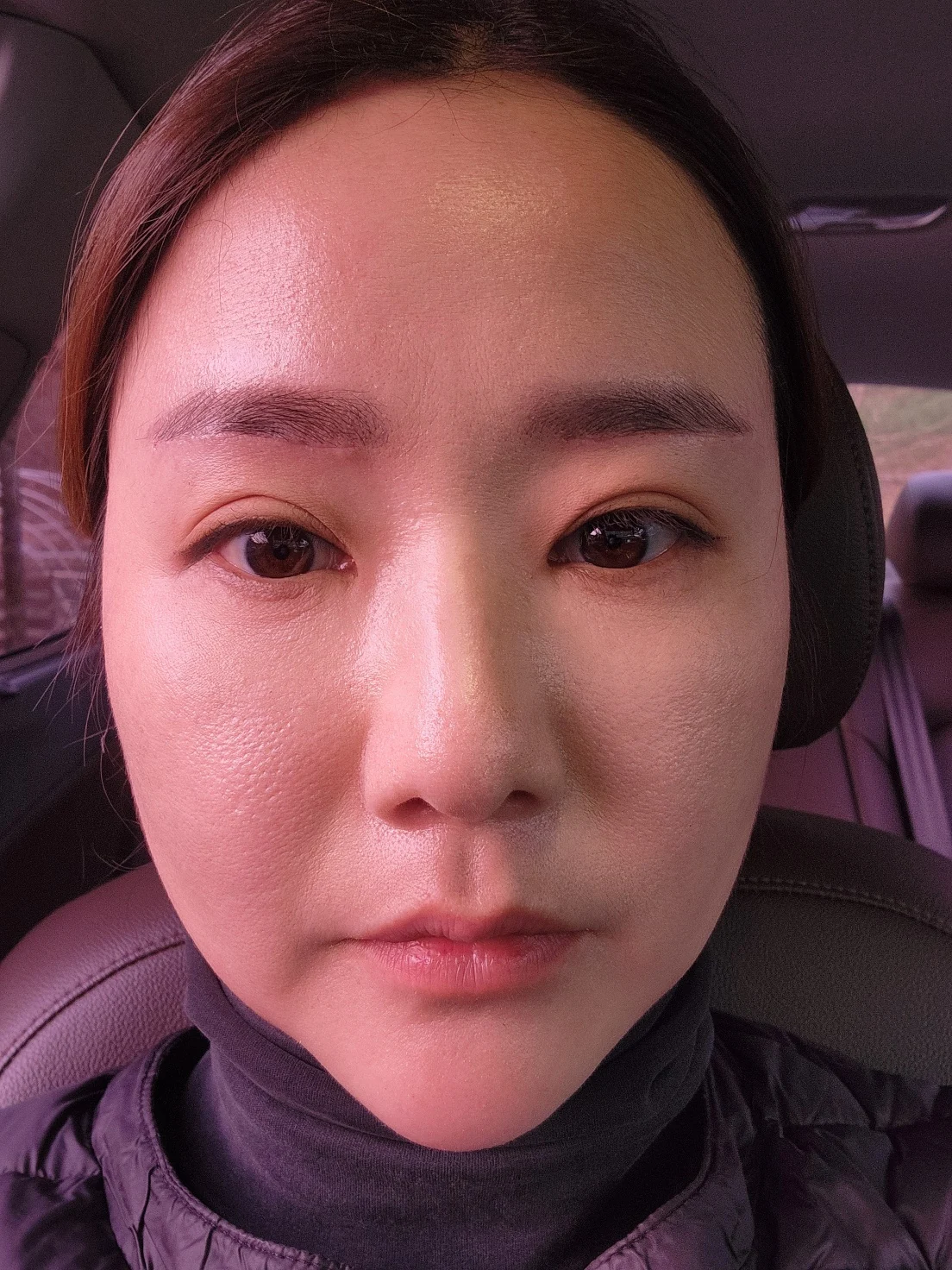 Eye-area surgery: before and recovery through four months · Case 046 at Answer Plastic Surgery. Front view 1 week at Answer Plastic Surgery.