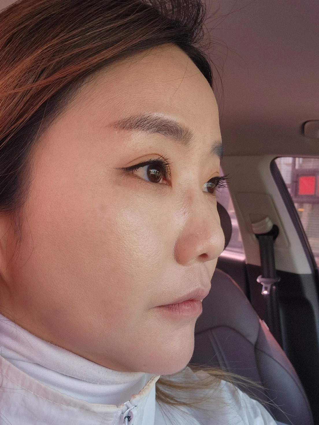 Eye-area surgery: before and recovery through four months · Case 046 at Answer Plastic Surgery. Angled view 2 months at Answer Plastic Surgery.