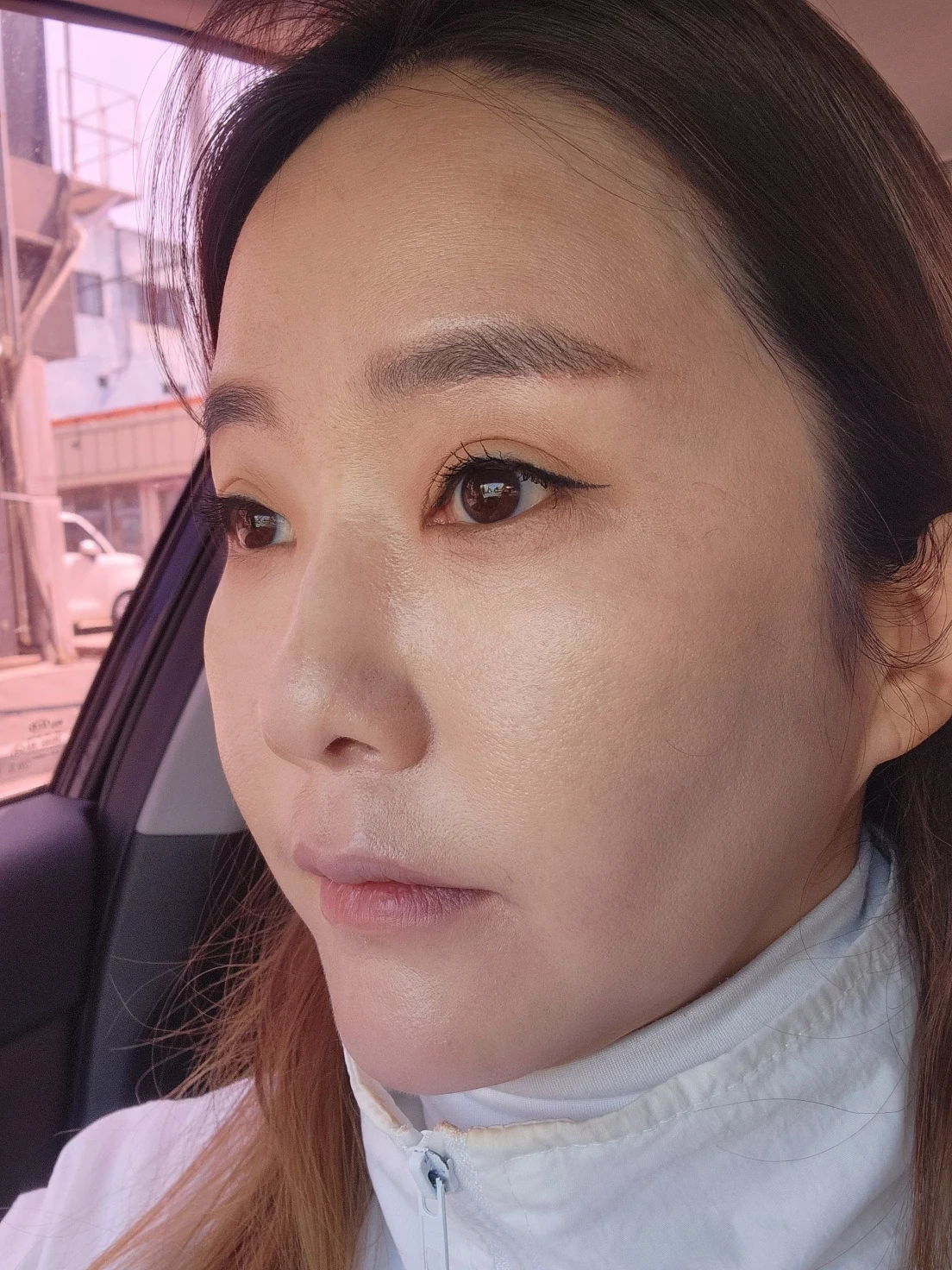 Eye-area surgery: before and recovery through four months · Case 046 at Answer Plastic Surgery. Opposite angled view 2 months at Answer Plastic Surgery.
