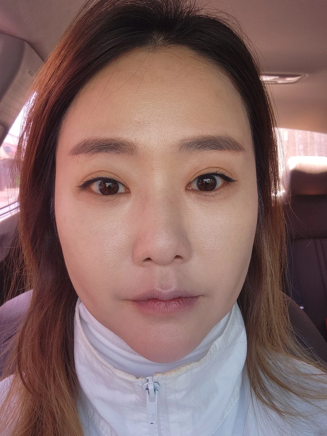 Eye-area surgery: before and recovery through four months · Case 046 at Answer Plastic Surgery. Front view 2 months at Answer Plastic Surgery.