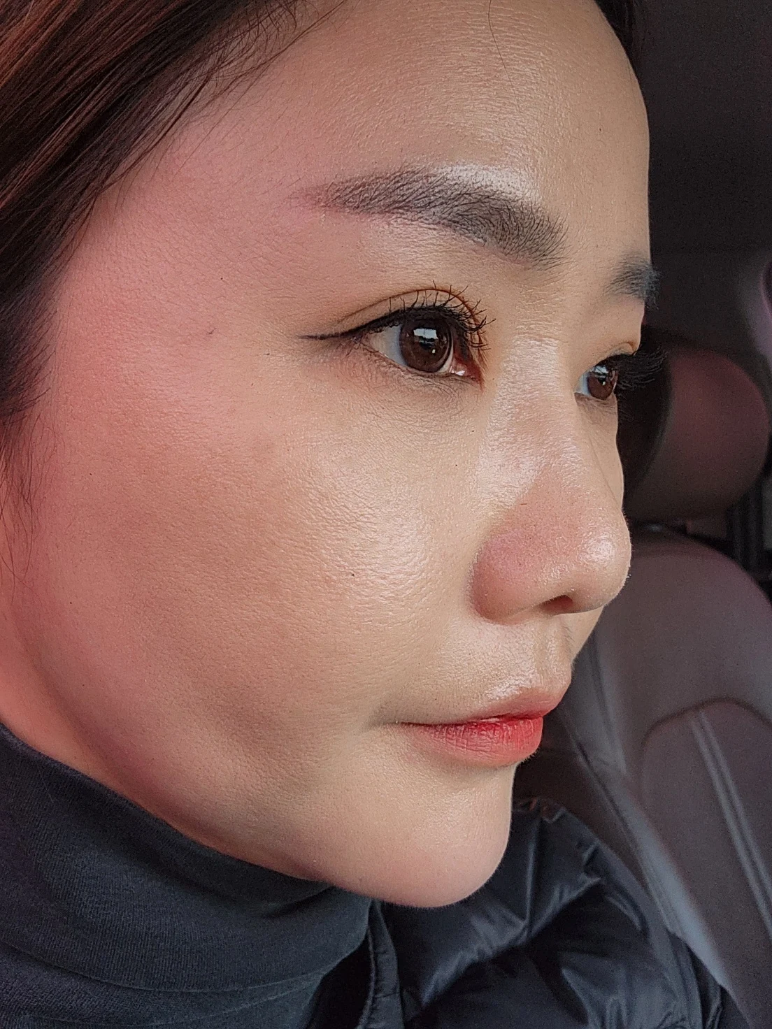 Eye-area surgery: before and recovery through four months · Case 046 at Answer Plastic Surgery. Angled view 2 weeks at Answer Plastic Surgery.