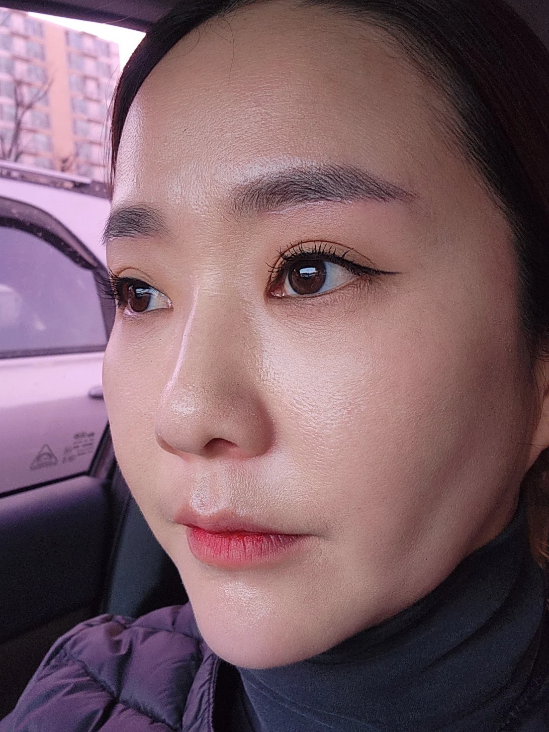 Eye-area surgery: before and recovery through four months · Case 046 at Answer Plastic Surgery. Opposite angled view 2 weeks at Answer Plastic Surgery.