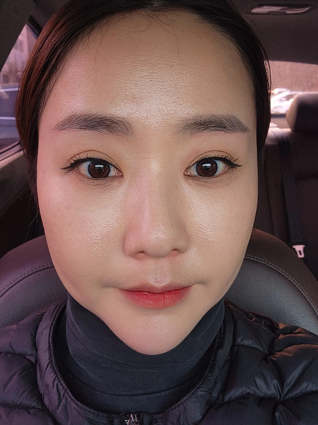 Eye-area surgery: before and recovery through four months · Case 046 at Answer Plastic Surgery. Front view 2 weeks at Answer Plastic Surgery.
