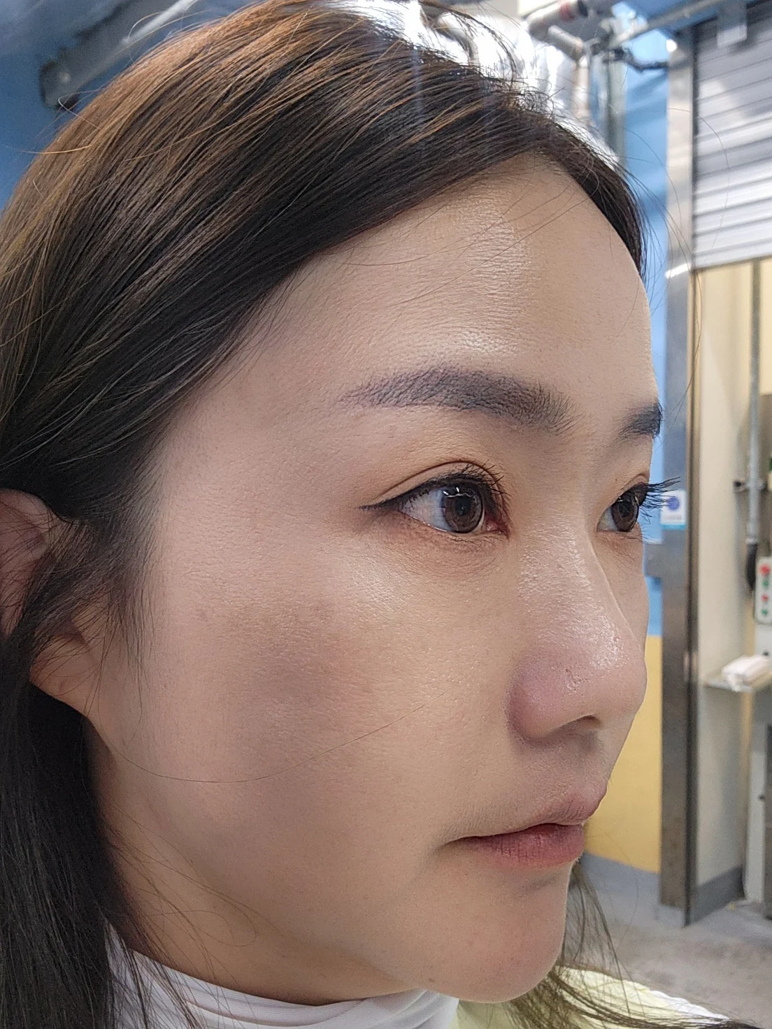 Eye-area surgery: before and recovery through four months · Case 046 at Answer Plastic Surgery. Angled view 4 months at Answer Plastic Surgery.