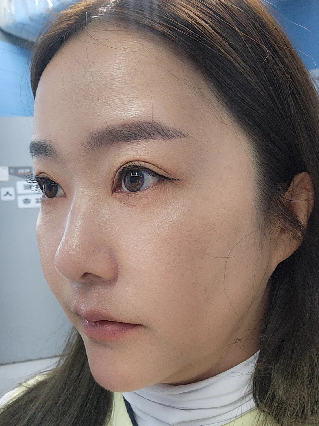 Eye-area surgery: before and recovery through four months · Case 046 at Answer Plastic Surgery. Opposite angled view 4 months at Answer Plastic Surgery.
