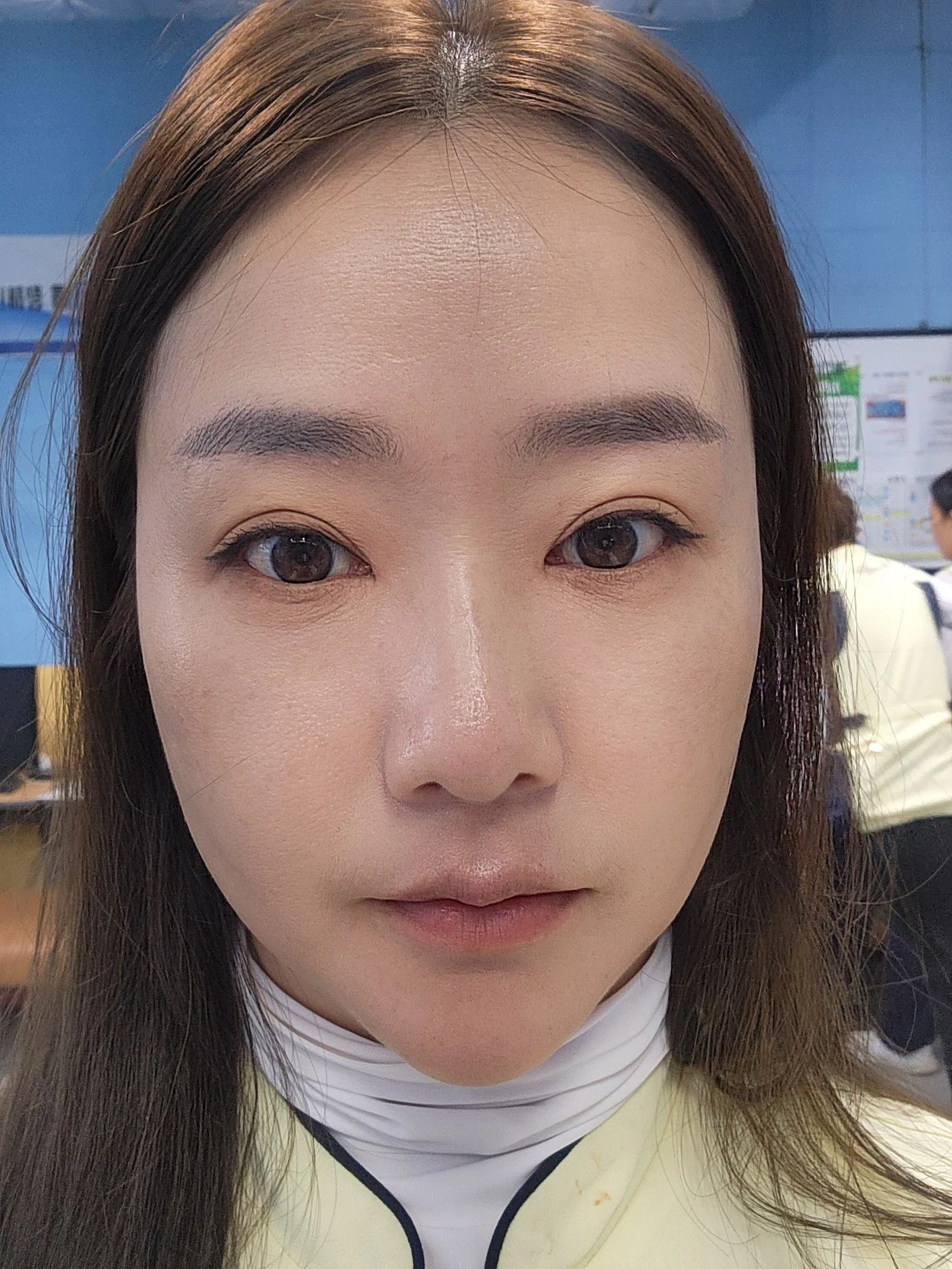 Eye-area surgery: before and recovery through four months · Case 046 at Answer Plastic Surgery. Front view 4 months at Answer Plastic Surgery.