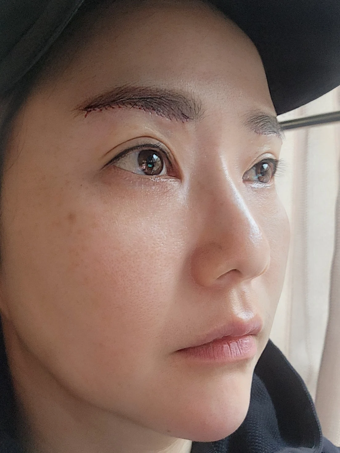 Eye-area surgery: before and recovery through four months · Case 046 at Answer Plastic Surgery. Angled view surgery day at Answer Plastic Surgery.