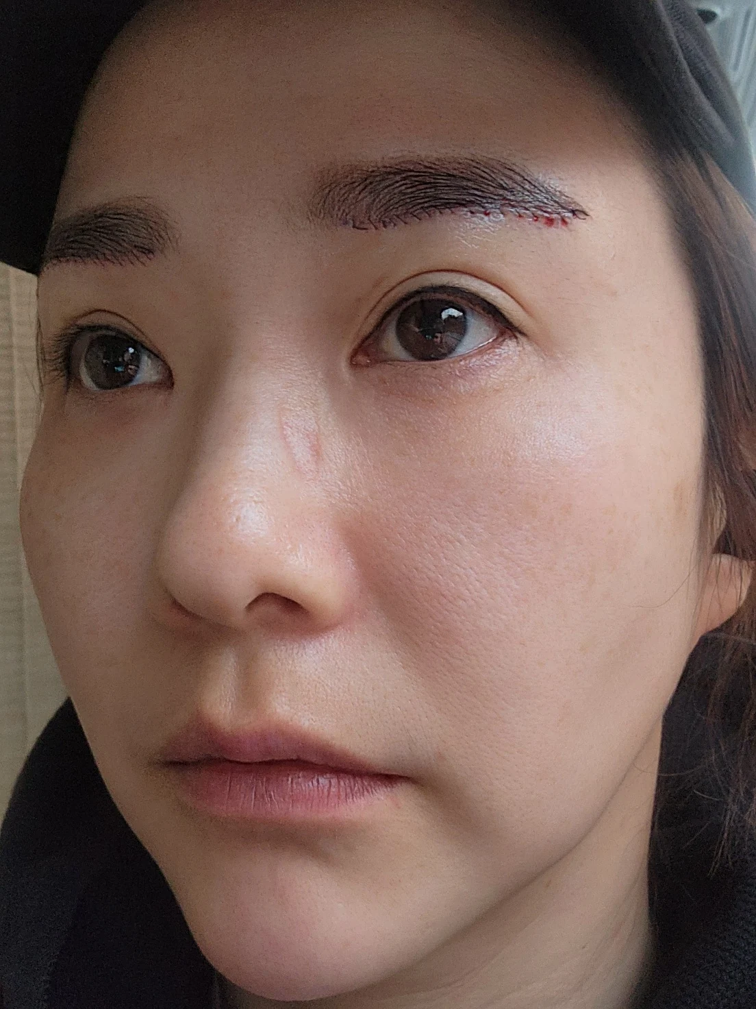 Eye-area surgery: before and recovery through four months · Case 046 at Answer Plastic Surgery. Opposite angled view surgery day at Answer Plastic Surgery.