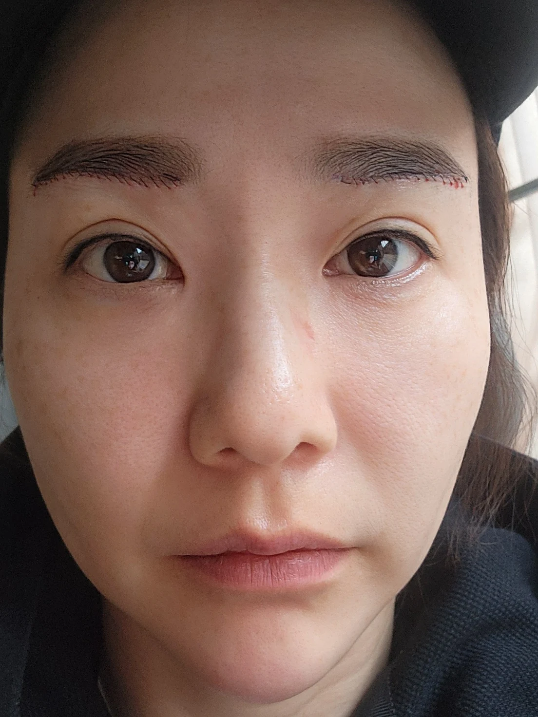 Eye-area surgery: before and recovery through four months · Case 046 at Answer Plastic Surgery. Front view surgery day at Answer Plastic Surgery.