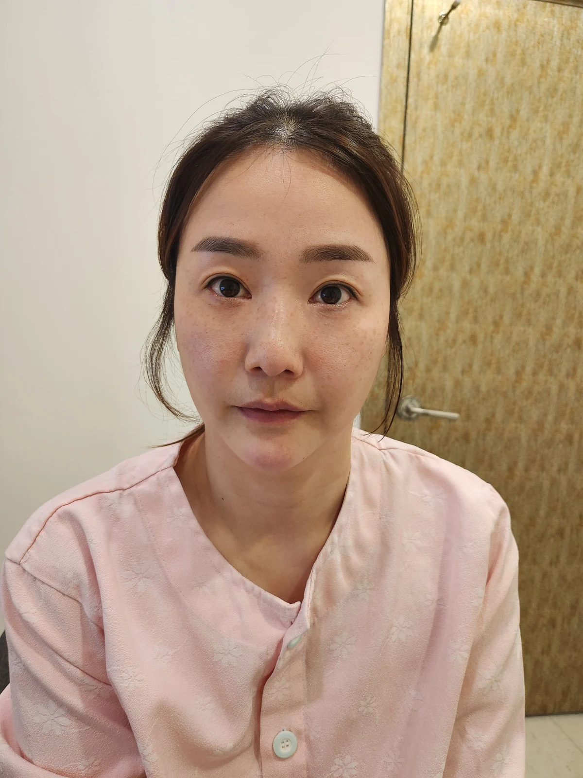 Eye-area surgery: before and recovery through four months · Case 046 at Answer Plastic Surgery. Front view before at Answer Plastic Surgery.