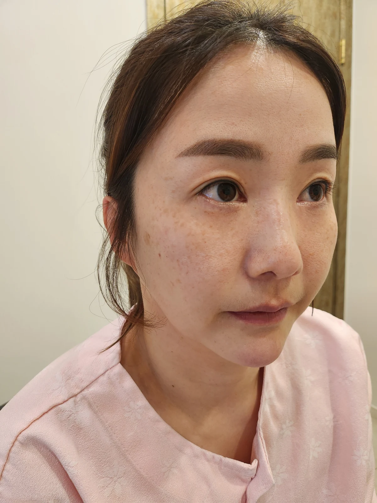 Eye-area surgery: before and recovery through four months · Case 046 at Answer Plastic Surgery. Angled view before at Answer Plastic Surgery.