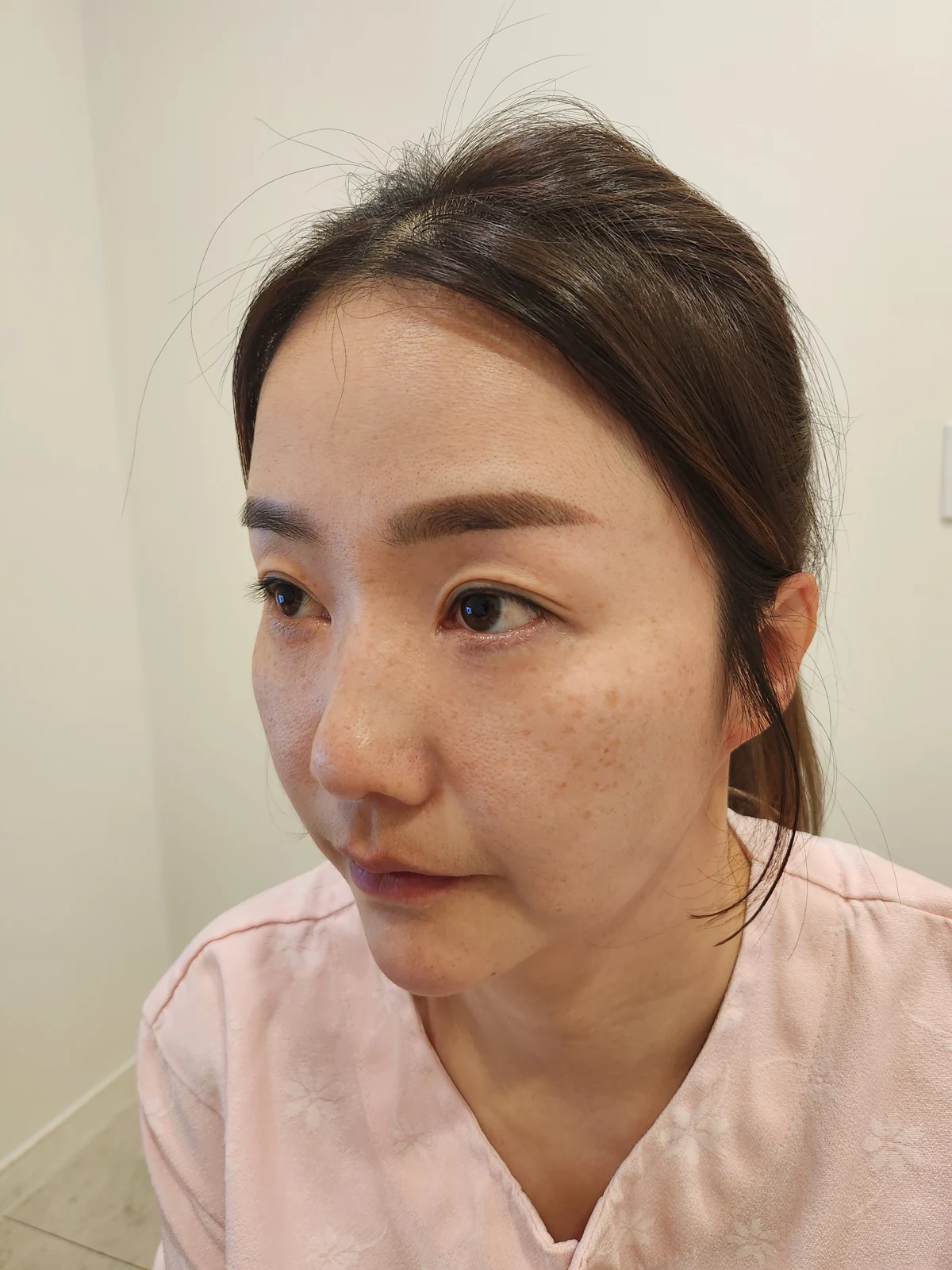 Eye-area surgery: before and recovery through four months · Case 046 at Answer Plastic Surgery. Opposite angled view before at Answer Plastic Surgery.