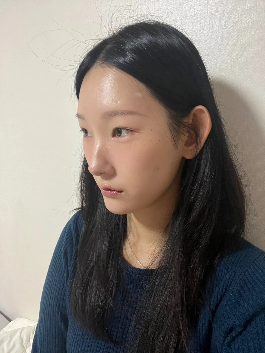 Inner-corner and revision outer-corner surgery: three-month timeline · Case 047 at Answer Plastic Surgery. Angled view 1 month at Answer Plastic Surgery.