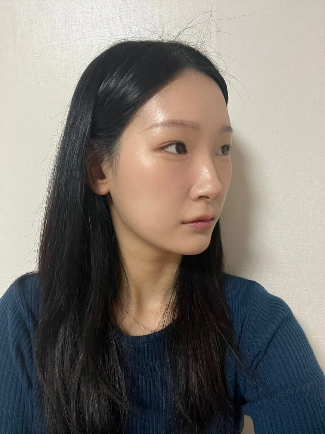 Inner-corner and revision outer-corner surgery: three-month timeline · Case 047 at Answer Plastic Surgery. Opposite angled view 1 month at Answer Plastic Surgery.