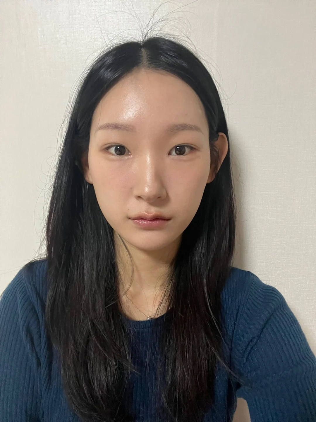 Inner-corner and revision outer-corner surgery: three-month timeline · Case 047 at Answer Plastic Surgery. Front view 1 month at Answer Plastic Surgery.