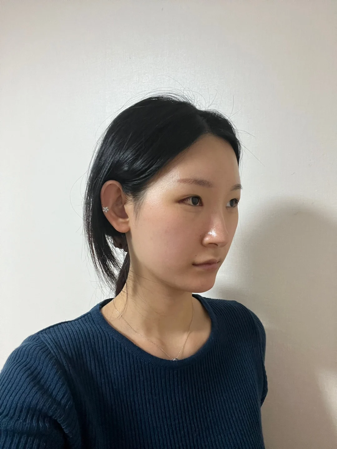 Inner-corner and revision outer-corner surgery: three-month timeline · Case 047 at Answer Plastic Surgery. Angled view 1 week at Answer Plastic Surgery.