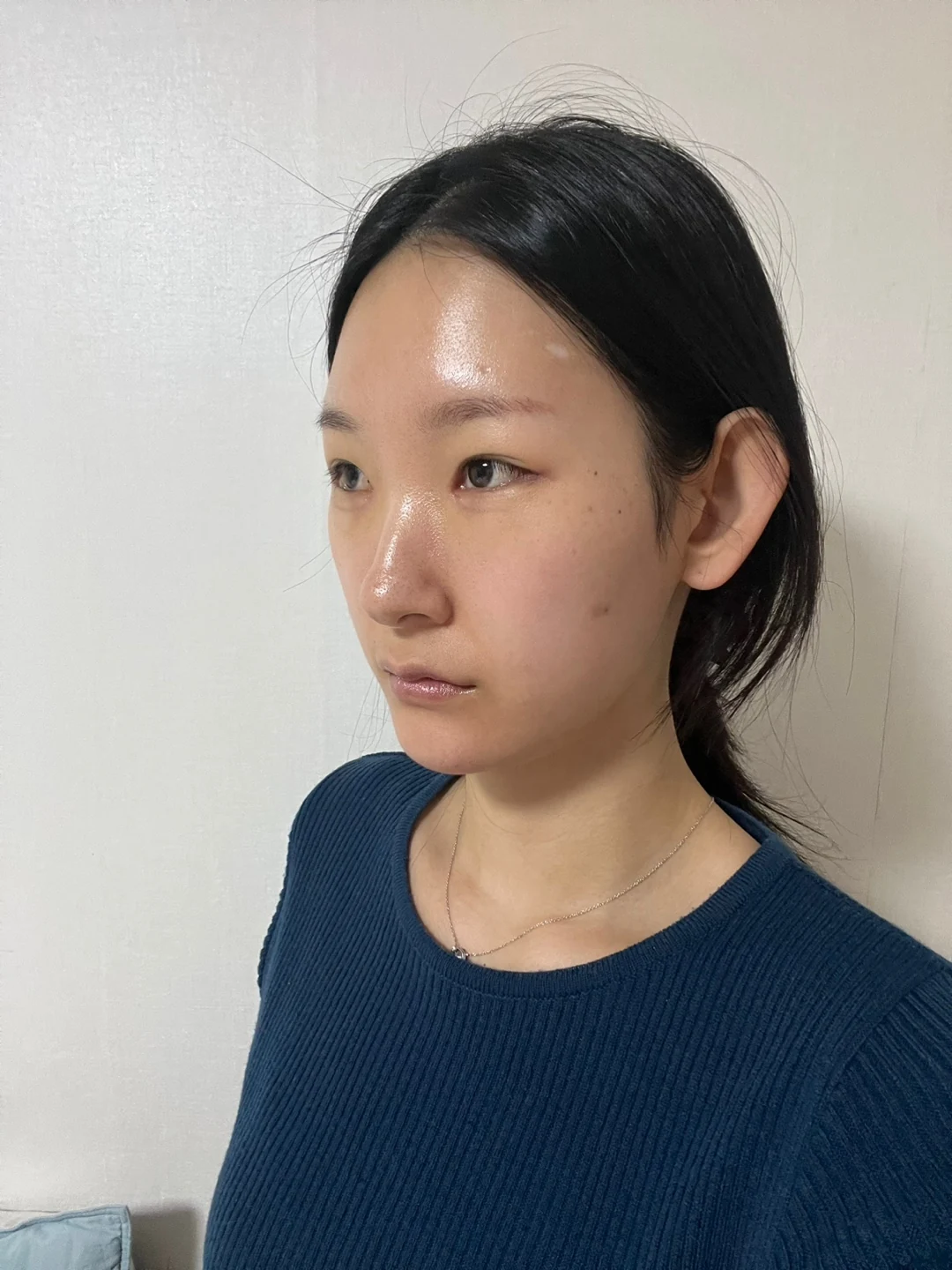 Inner-corner and revision outer-corner surgery: three-month timeline · Case 047 at Answer Plastic Surgery. Opposite angled view 1 week at Answer Plastic Surgery.