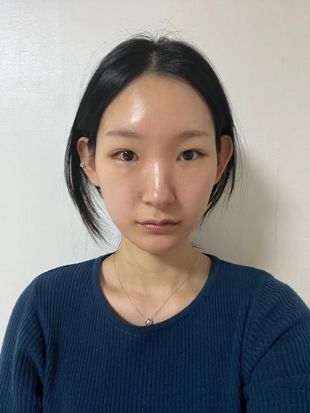 Inner-corner and revision outer-corner surgery: three-month timeline · Case 047 at Answer Plastic Surgery. Front view 1 week at Answer Plastic Surgery.