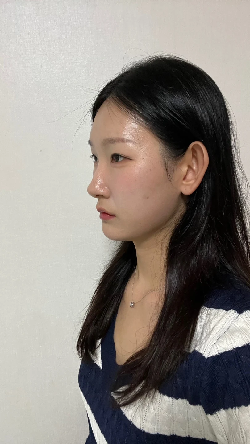 Inner-corner and revision outer-corner surgery: three-month timeline · Case 047 at Answer Plastic Surgery. Angled view 2 months at Answer Plastic Surgery.