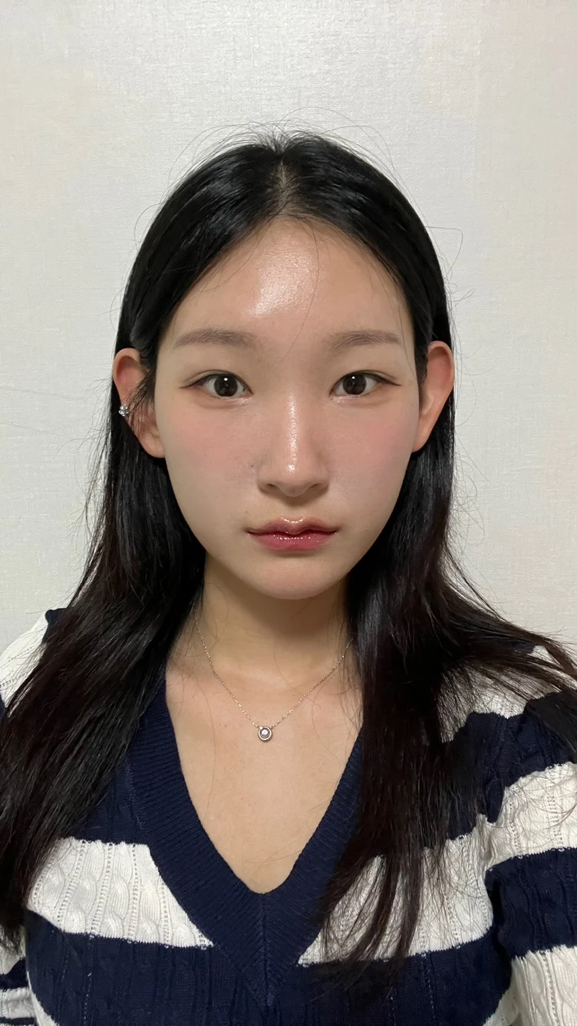 Inner-corner and revision outer-corner surgery: three-month timeline · Case 047 at Answer Plastic Surgery. Front view 2 months at Answer Plastic Surgery.
