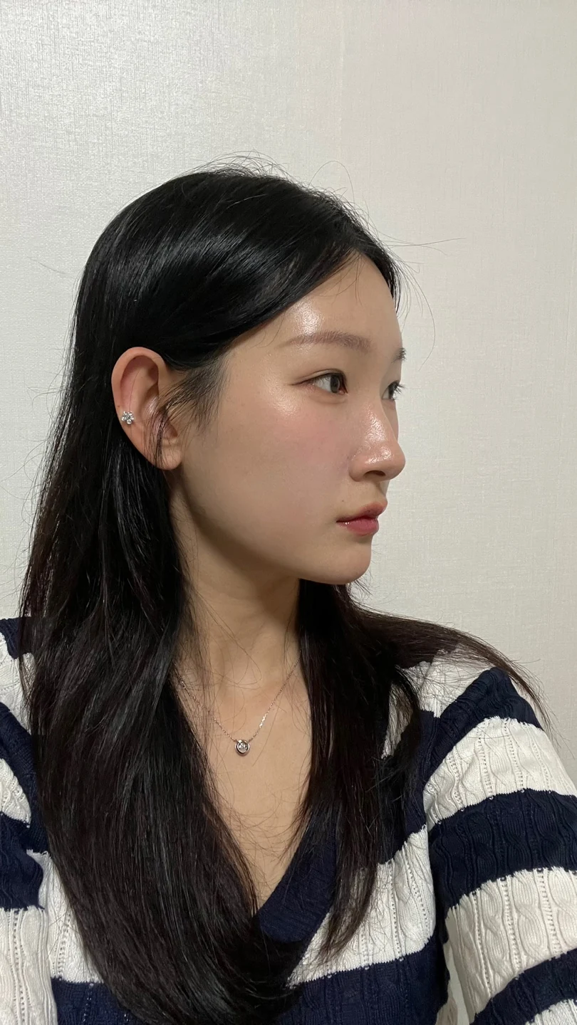 Inner-corner and revision outer-corner surgery: three-month timeline · Case 047 at Answer Plastic Surgery. Opposite angled view 2 months at Answer Plastic Surgery.