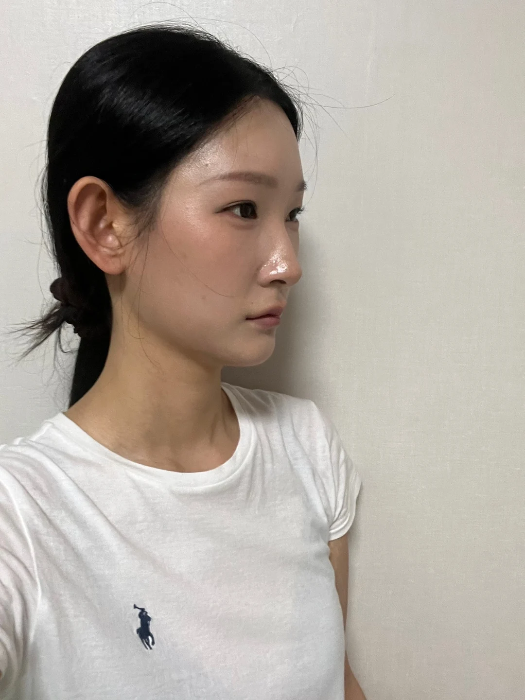 Inner-corner and revision outer-corner surgery: three-month timeline · Case 047 at Answer Plastic Surgery. Angled view 3 months at Answer Plastic Surgery.