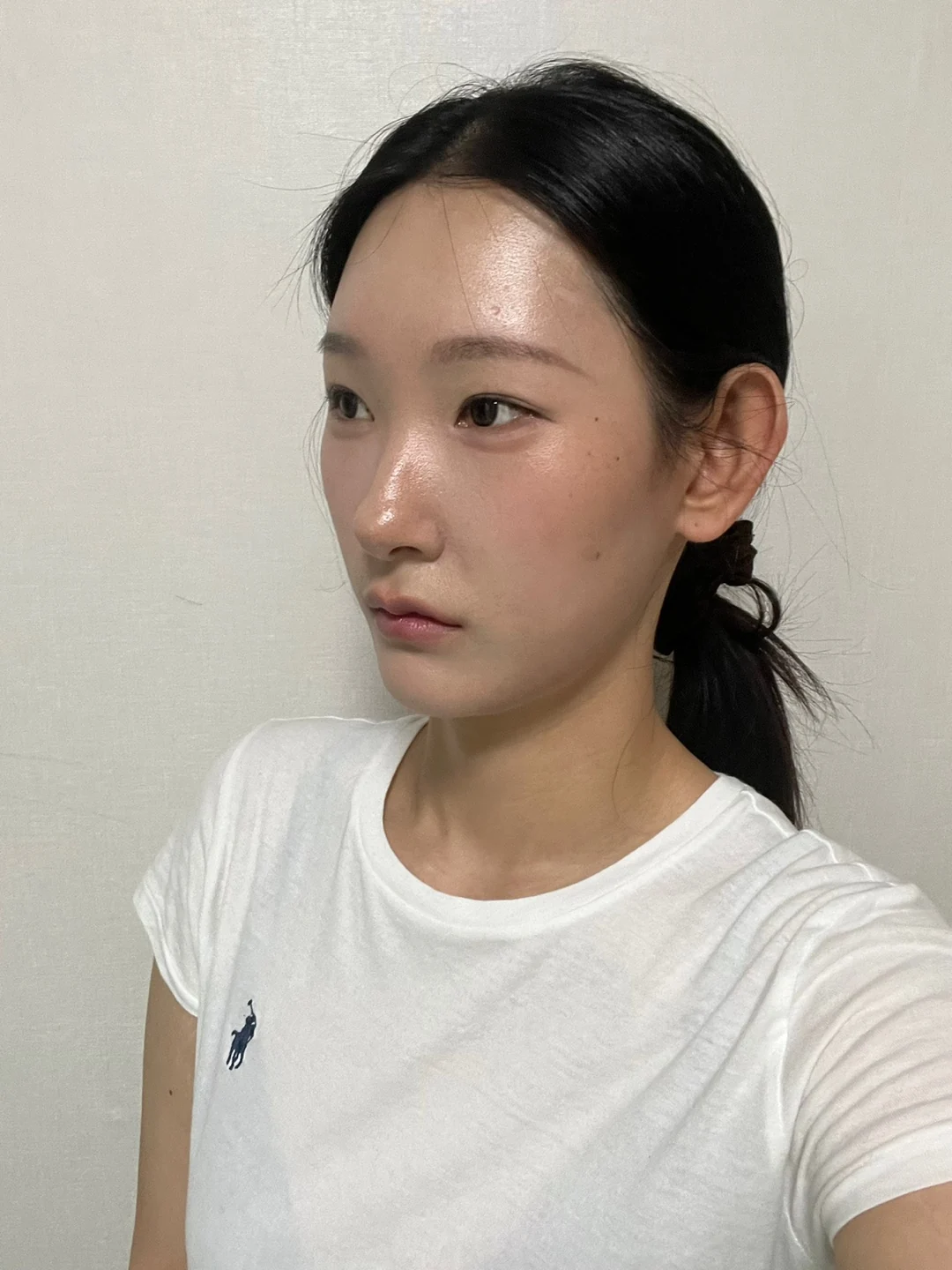 Inner-corner and revision outer-corner surgery: three-month timeline · Case 047 at Answer Plastic Surgery. Opposite angled view 3 months at Answer Plastic Surgery.