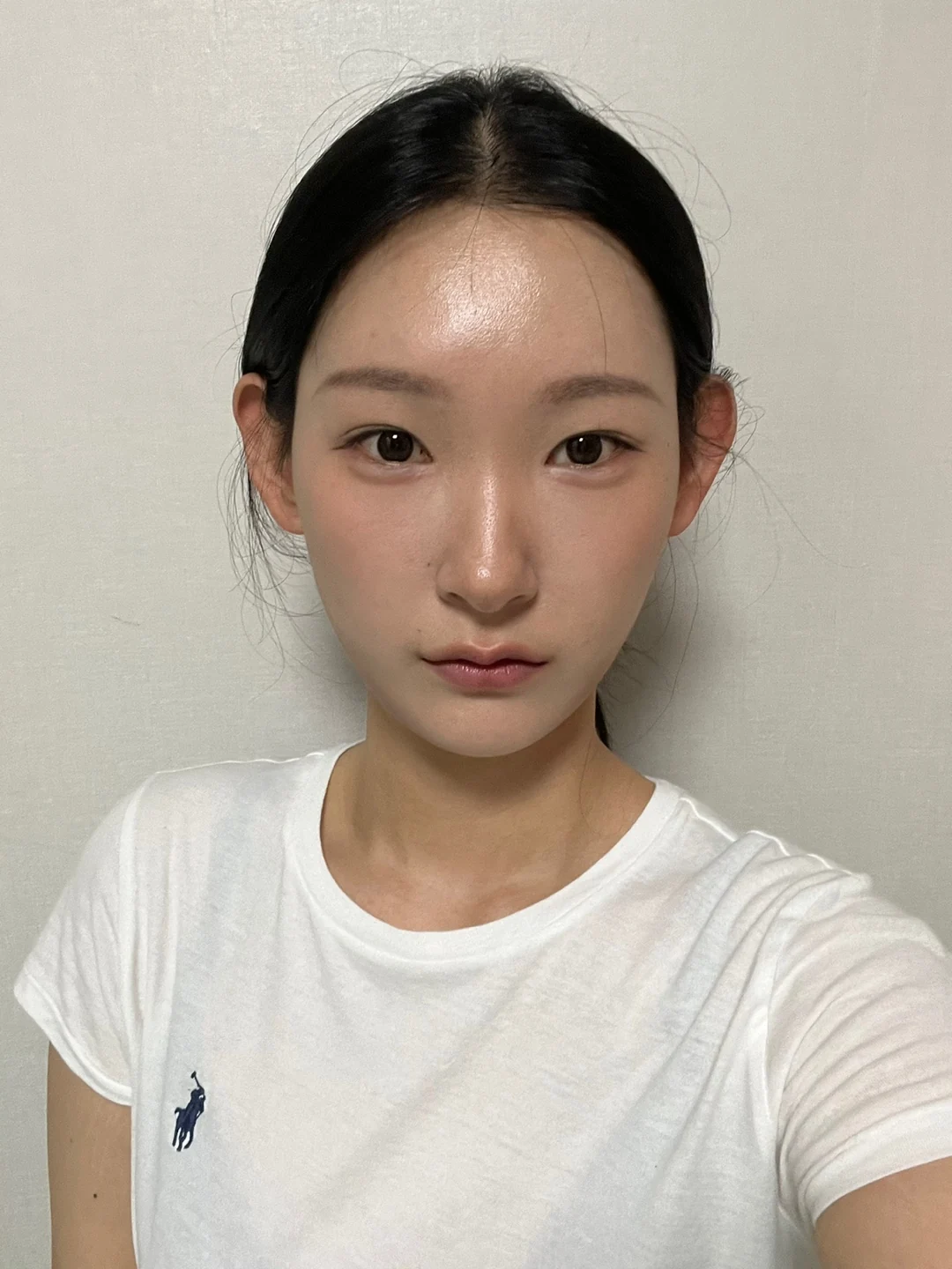 Inner-corner and revision outer-corner surgery: three-month timeline · Case 047 at Answer Plastic Surgery. Front view 3 months at Answer Plastic Surgery.