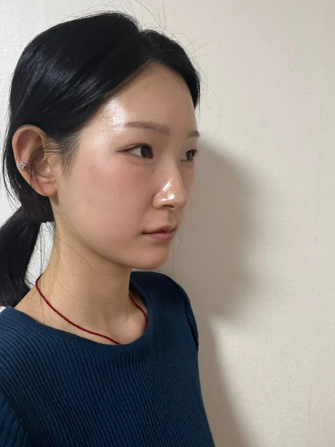 Inner-corner and revision outer-corner surgery: three-month timeline · Case 047 at Answer Plastic Surgery. Angled view 3 weeks at Answer Plastic Surgery.