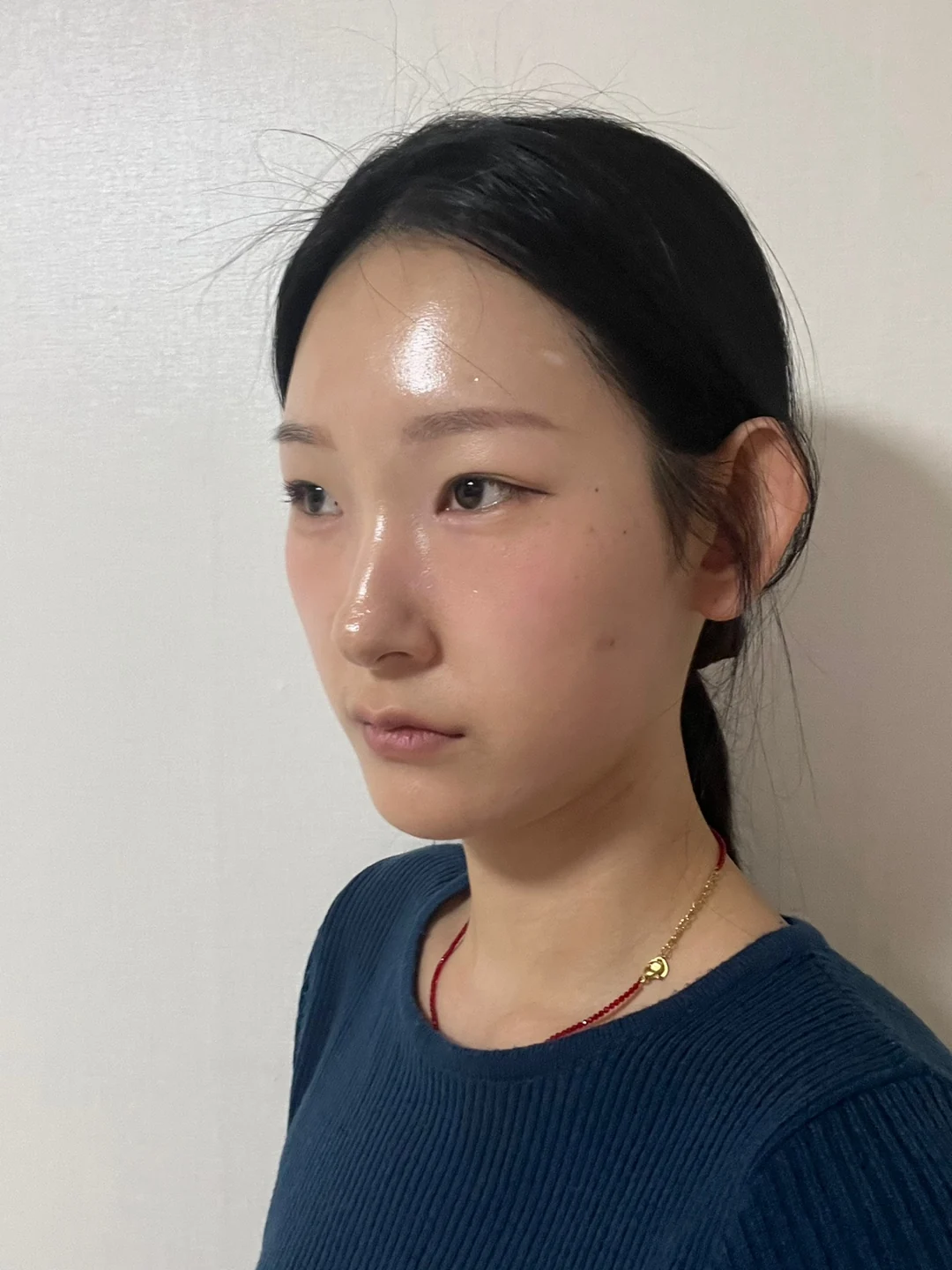 Inner-corner and revision outer-corner surgery: three-month timeline · Case 047 at Answer Plastic Surgery. Opposite angled view 3 weeks at Answer Plastic Surgery.