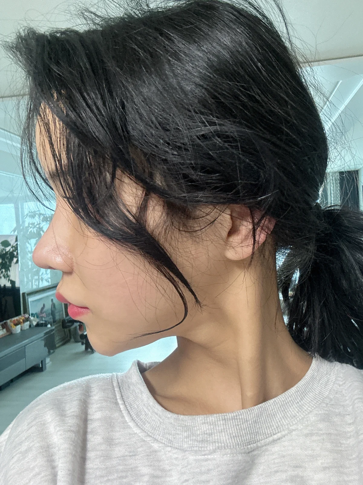Rhinoplasty and eye surgery: a two-month photo diary · Case 024 at Answer Plastic Surgery. Profile view after combined surgery — 1 month at Answer Plastic Surgery.