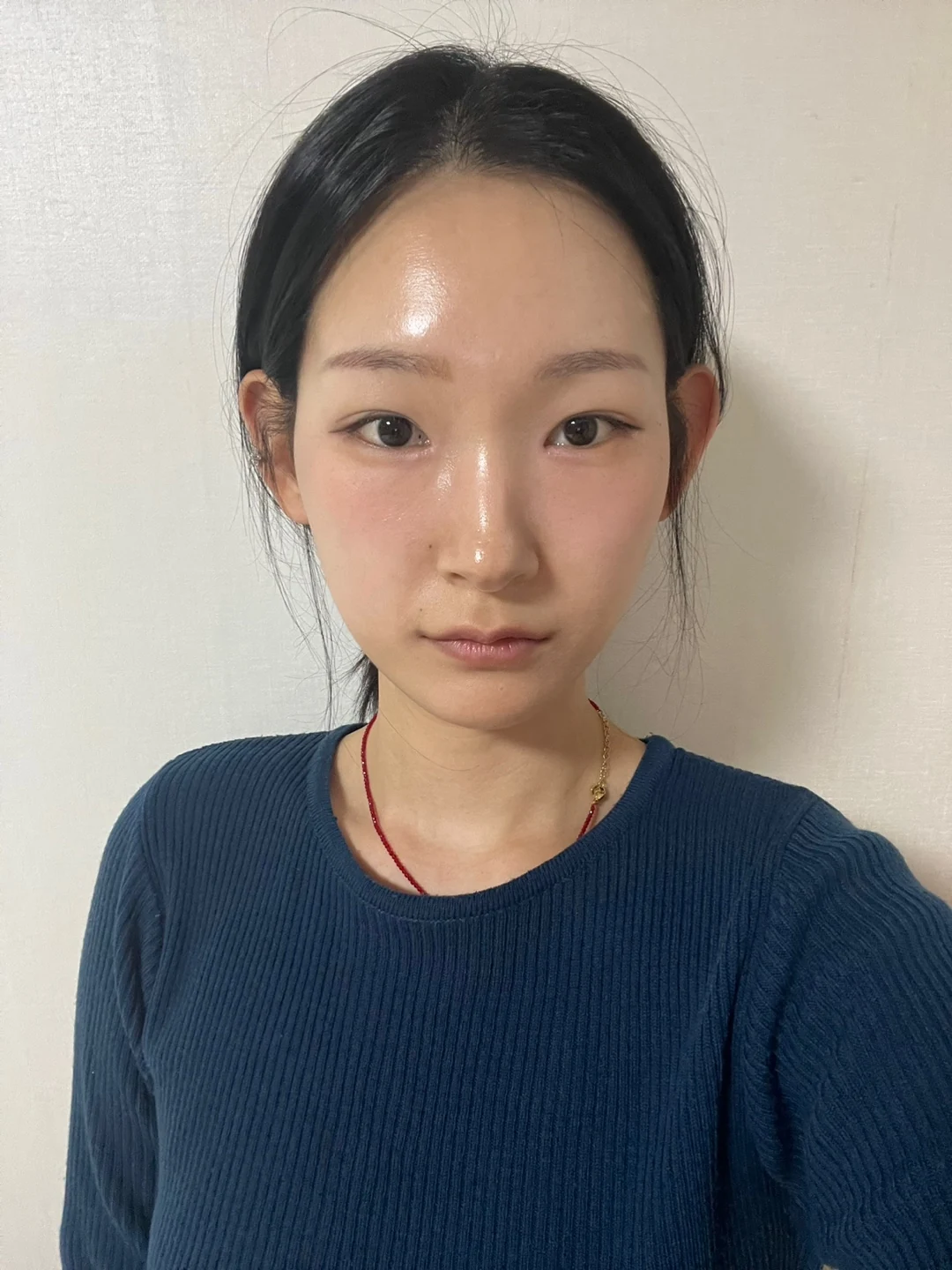 Inner-corner and revision outer-corner surgery: three-month timeline · Case 047 at Answer Plastic Surgery. Front view 3 weeks at Answer Plastic Surgery.