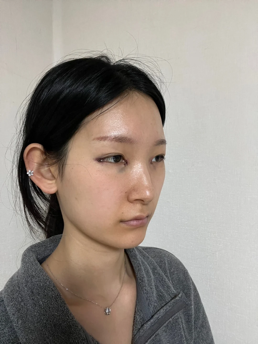 Inner-corner and revision outer-corner surgery: three-month timeline · Case 047 at Answer Plastic Surgery. Angled view surgery day at Answer Plastic Surgery.