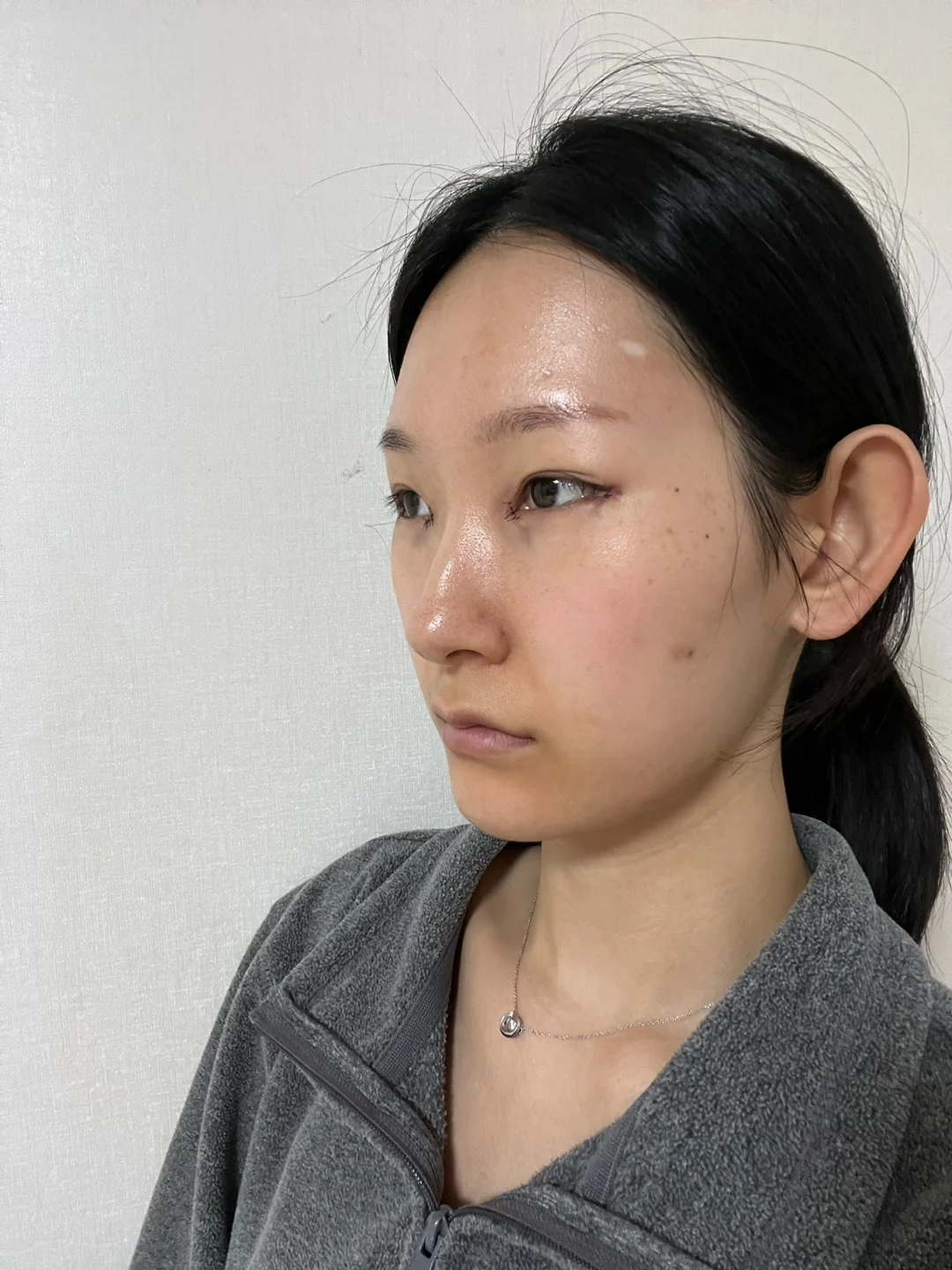 Inner-corner and revision outer-corner surgery: three-month timeline · Case 047 at Answer Plastic Surgery. Opposite angled view surgery day at Answer Plastic Surgery.