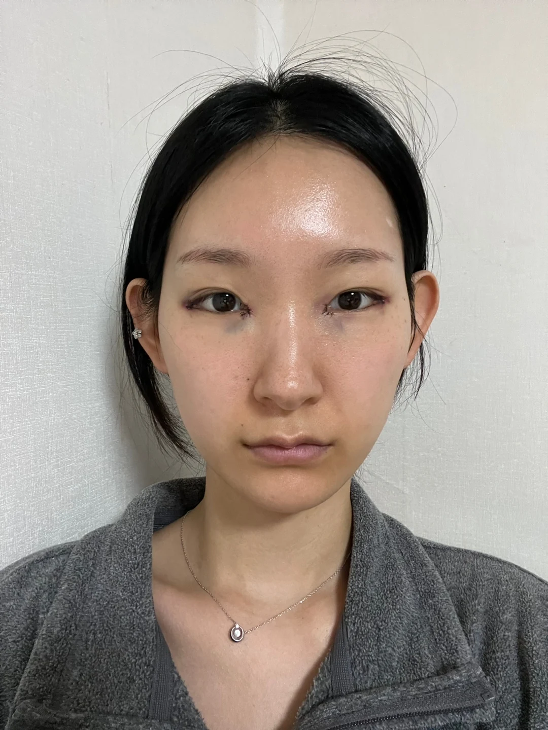 Inner-corner and revision outer-corner surgery: three-month timeline · Case 047 at Answer Plastic Surgery. Front view surgery day at Answer Plastic Surgery.