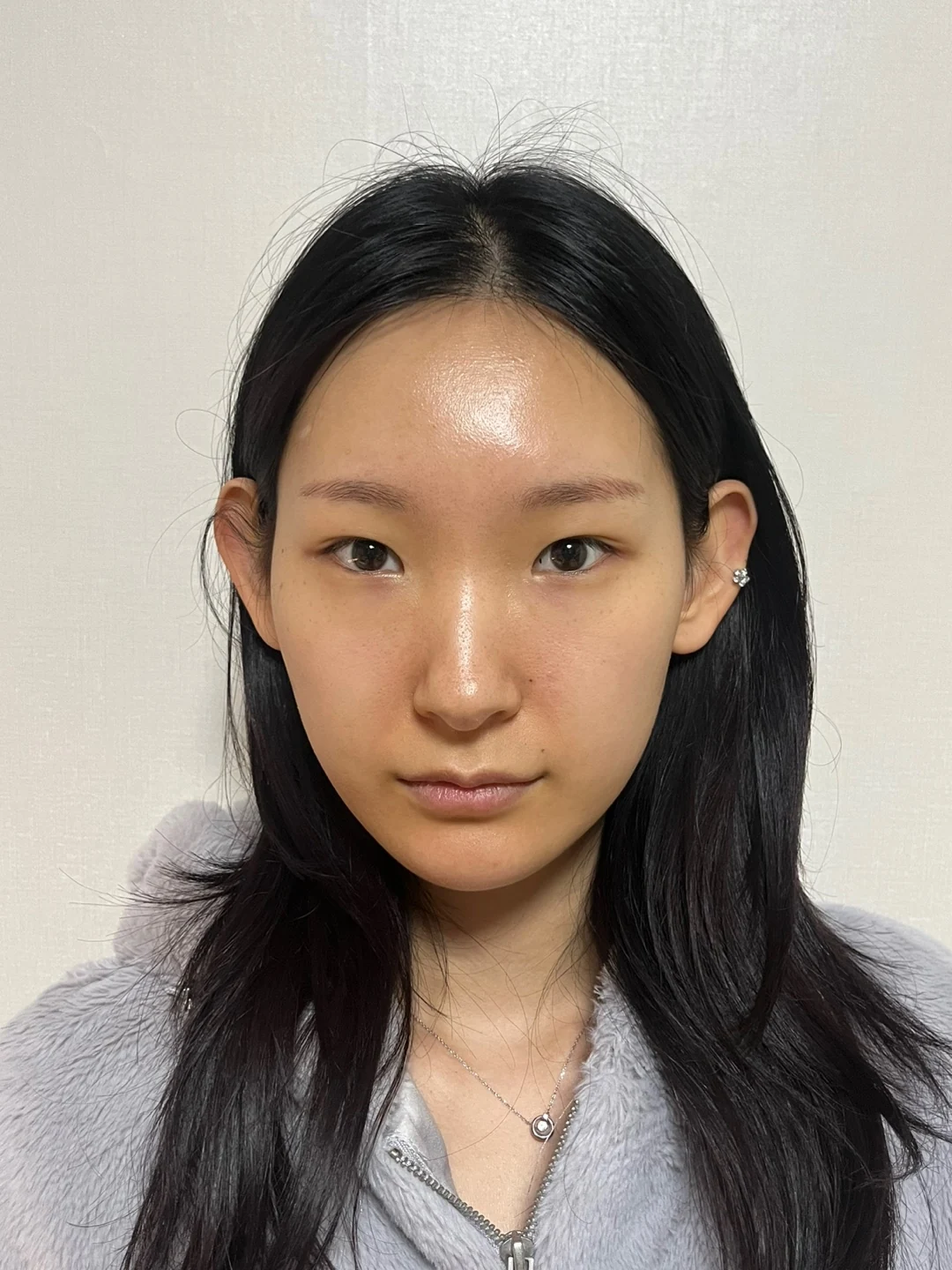 Inner-corner and revision outer-corner surgery: three-month timeline · Case 047 at Answer Plastic Surgery. Front view before at Answer Plastic Surgery.