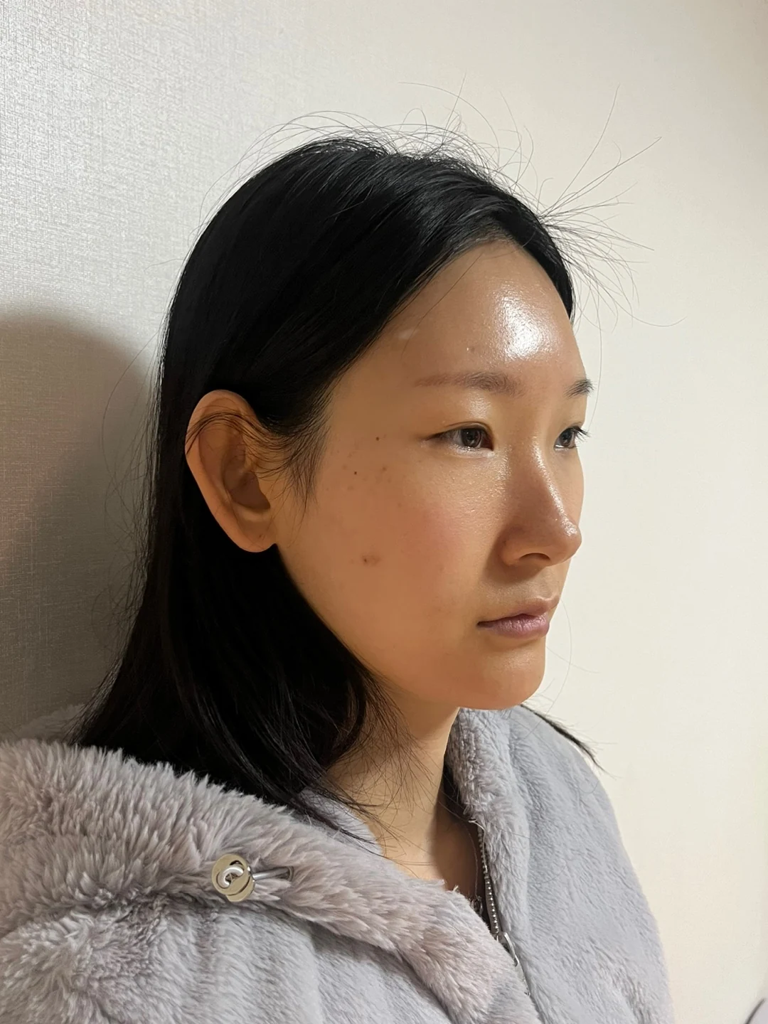 Inner-corner and revision outer-corner surgery: three-month timeline · Case 047 at Answer Plastic Surgery. Angled view before at Answer Plastic Surgery.