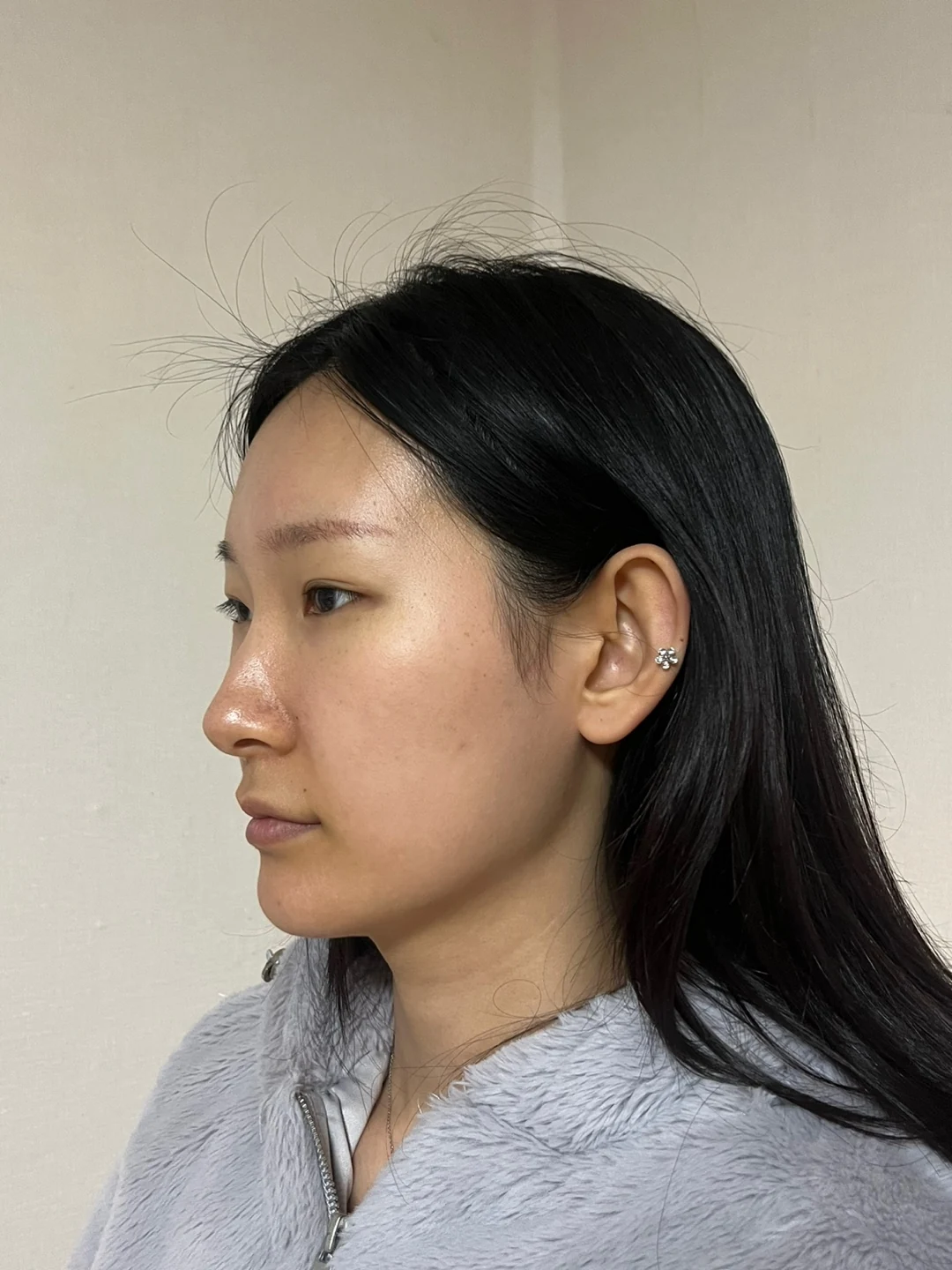 Inner-corner and revision outer-corner surgery: three-month timeline · Case 047 at Answer Plastic Surgery. Opposite angled view before at Answer Plastic Surgery.