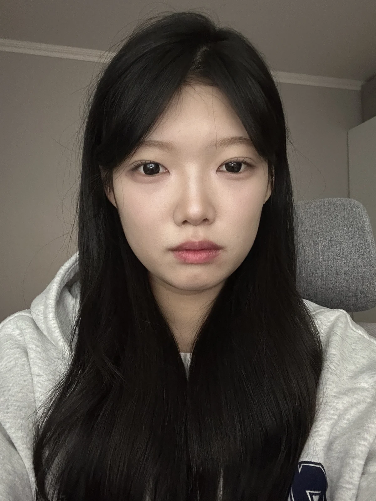 Non-incisional eyelid surgery: first three weeks · Case 048 at Answer Plastic Surgery. Front view 1 week at Answer Plastic Surgery.