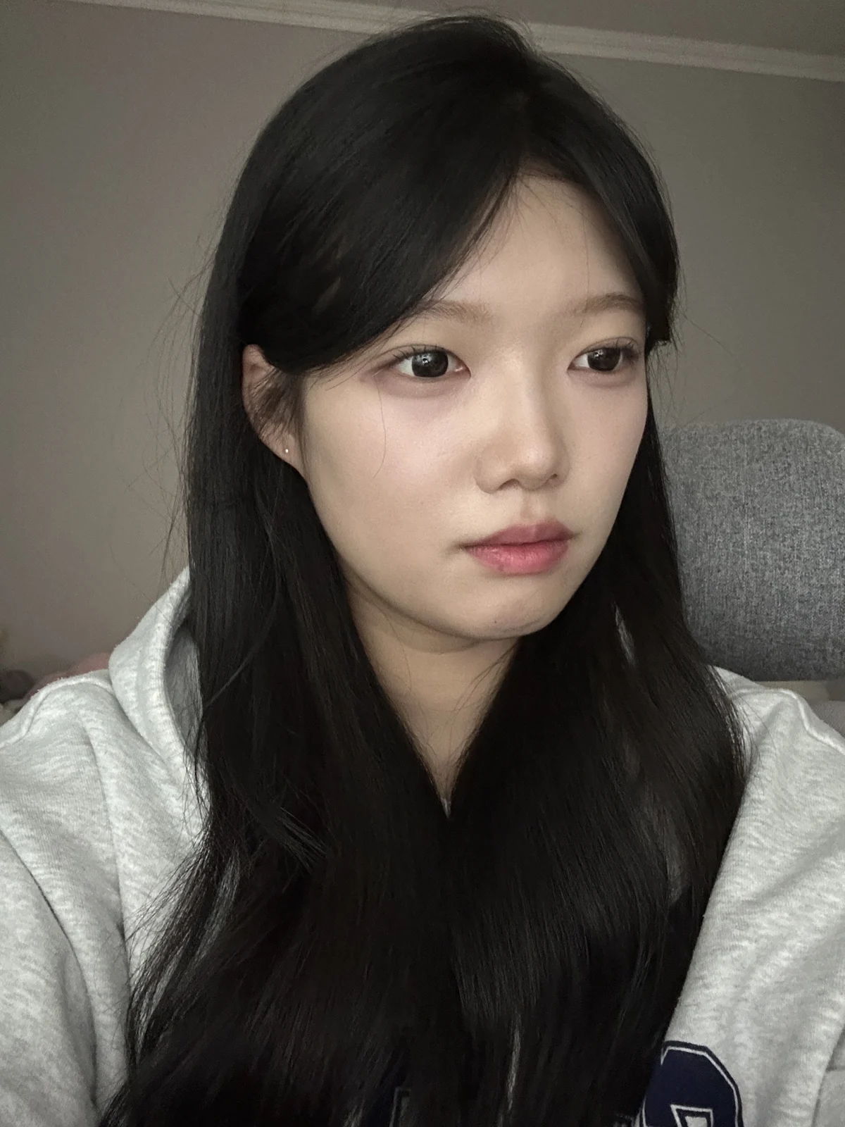 Non-incisional eyelid surgery: first three weeks · Case 048 at Answer Plastic Surgery. Angled view 1 week at Answer Plastic Surgery.
