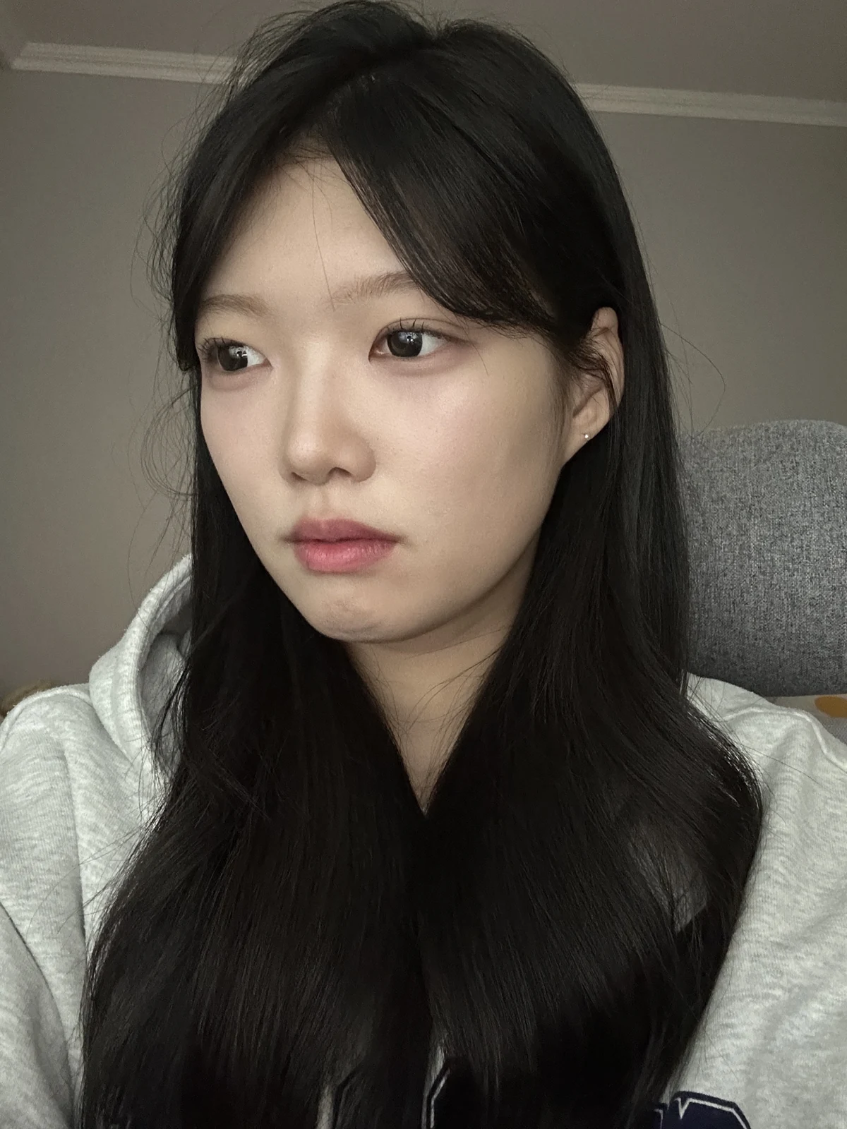 Non-incisional eyelid surgery: first three weeks · Case 048 at Answer Plastic Surgery. Opposite angled view 1 week at Answer Plastic Surgery.