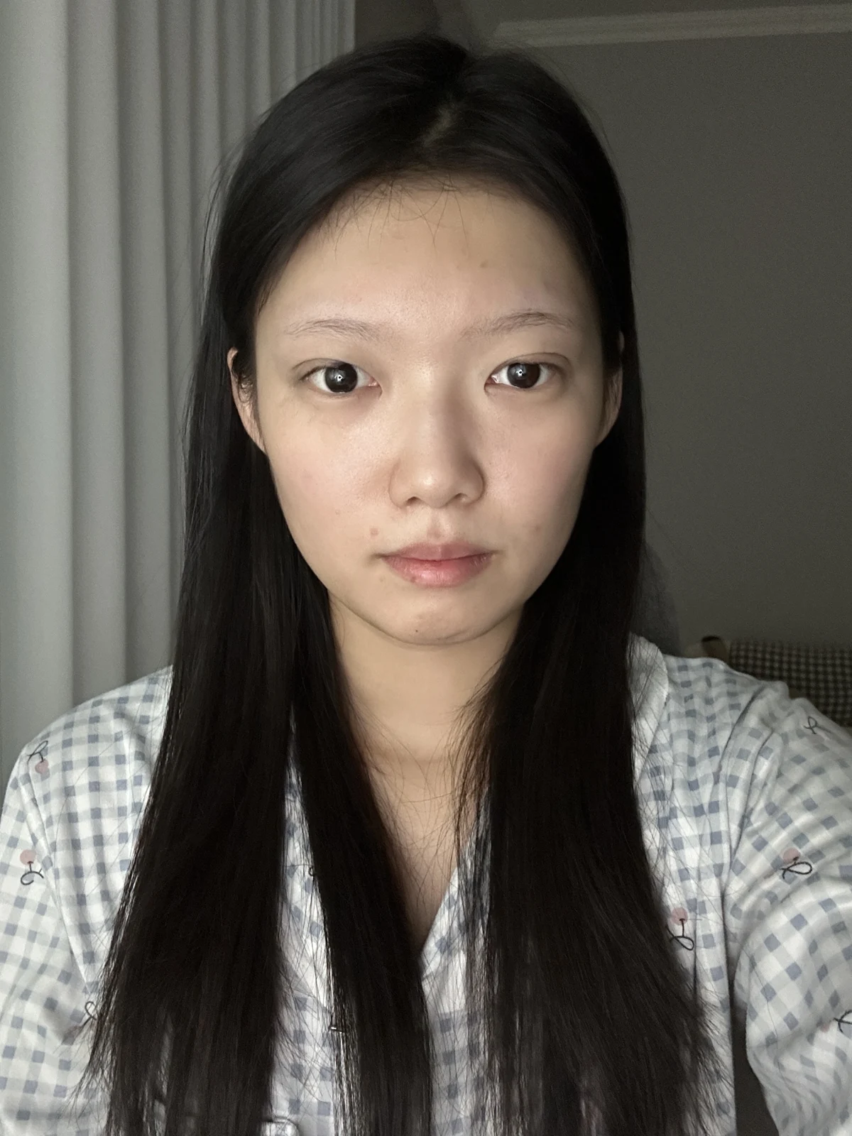 Non-incisional eyelid surgery: first three weeks · Case 048 at Answer Plastic Surgery. Front view surgery day at Answer Plastic Surgery.