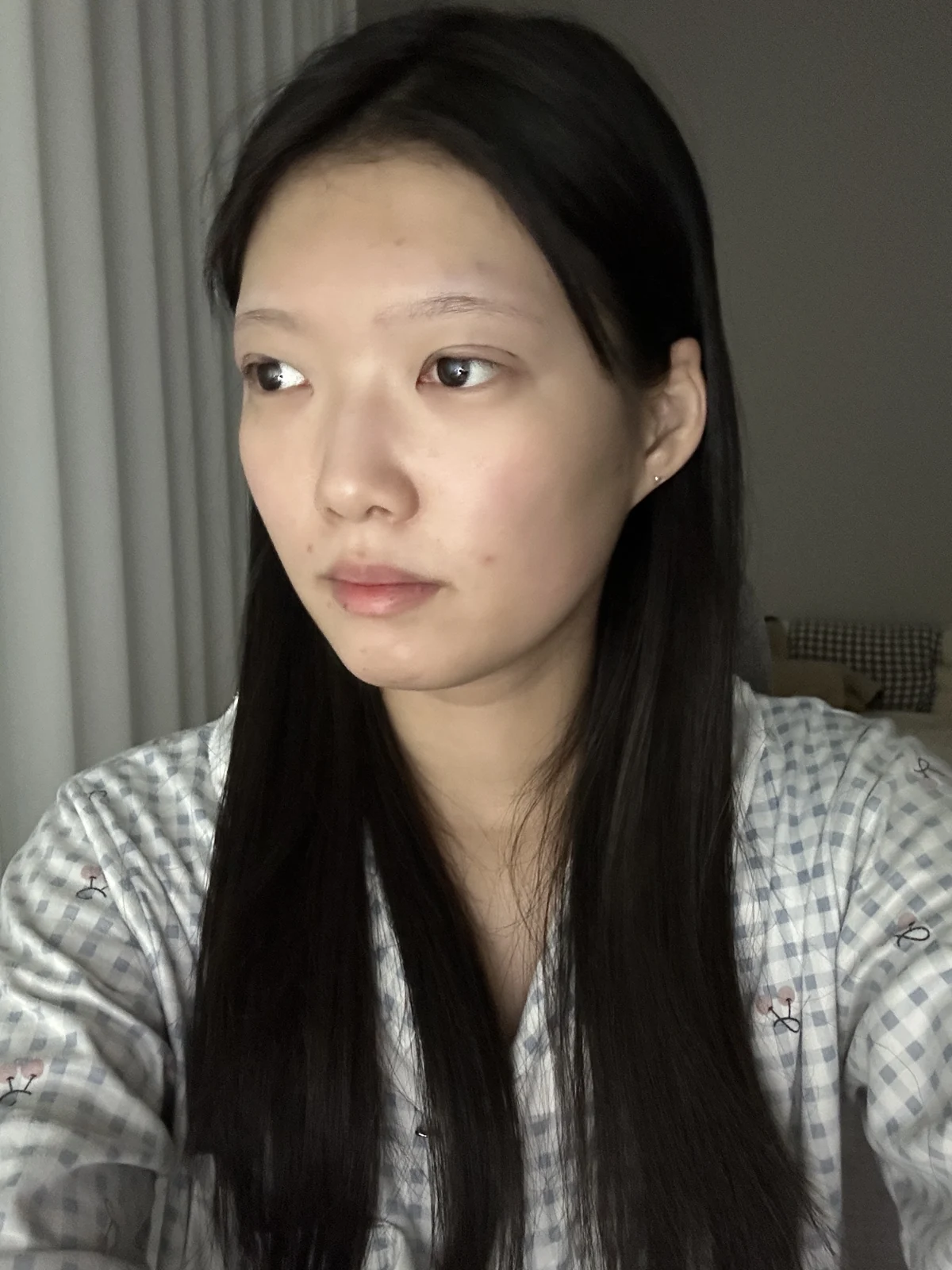 Non-incisional eyelid surgery: first three weeks · Case 048 at Answer Plastic Surgery. Angled view surgery day at Answer Plastic Surgery.
