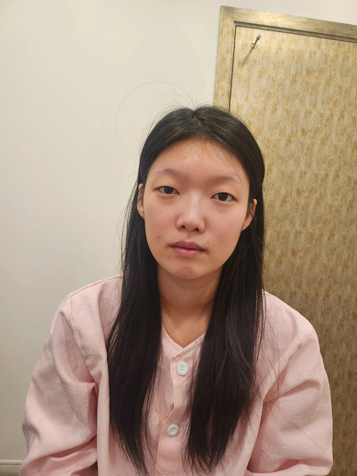Non-incisional eyelid surgery: first three weeks · Case 048 at Answer Plastic Surgery. Front view before at Answer Plastic Surgery.