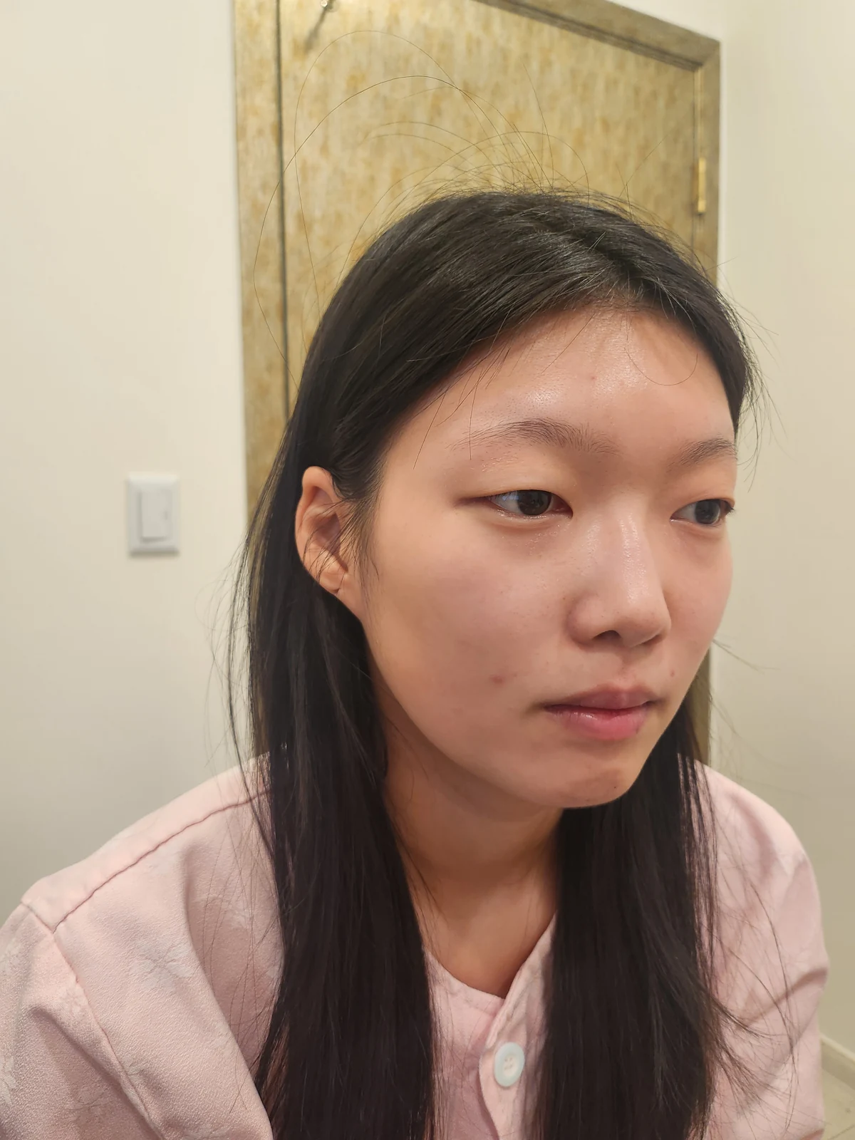 Non-incisional eyelid surgery: first three weeks · Case 048 at Answer Plastic Surgery. Angled view before at Answer Plastic Surgery.