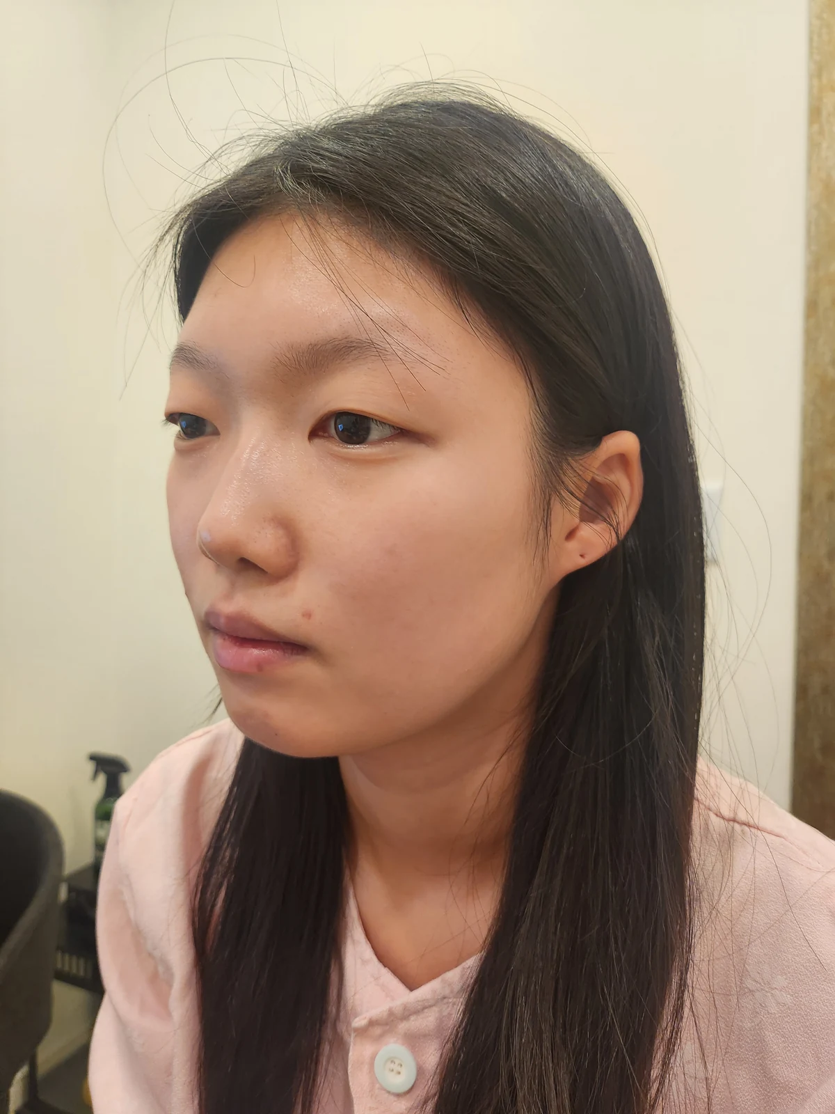 Non-incisional eyelid surgery: first three weeks · Case 048 at Answer Plastic Surgery. Opposite angled view before at Answer Plastic Surgery.